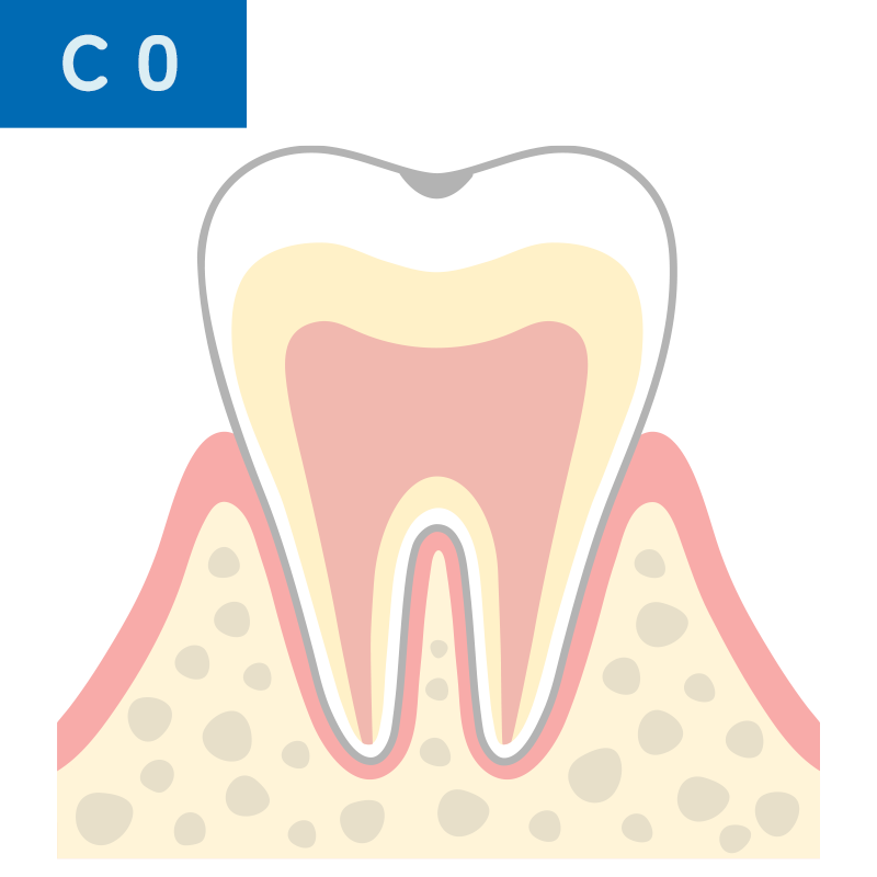 C0 虫歯の前兆