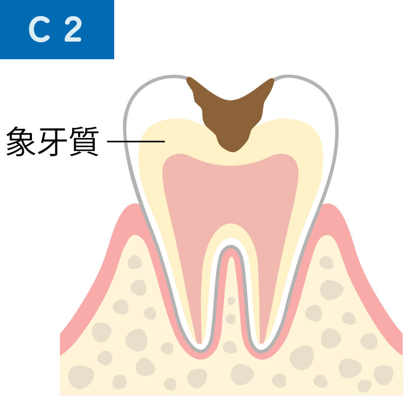 C2 象牙質の虫歯
