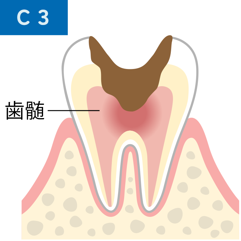 C3 歯髄（神経）に達した虫歯