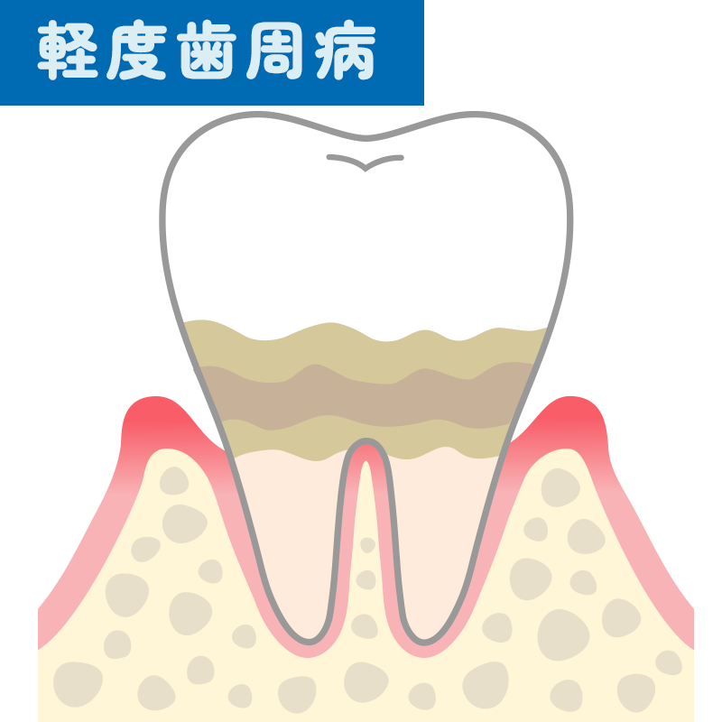軽度歯周病