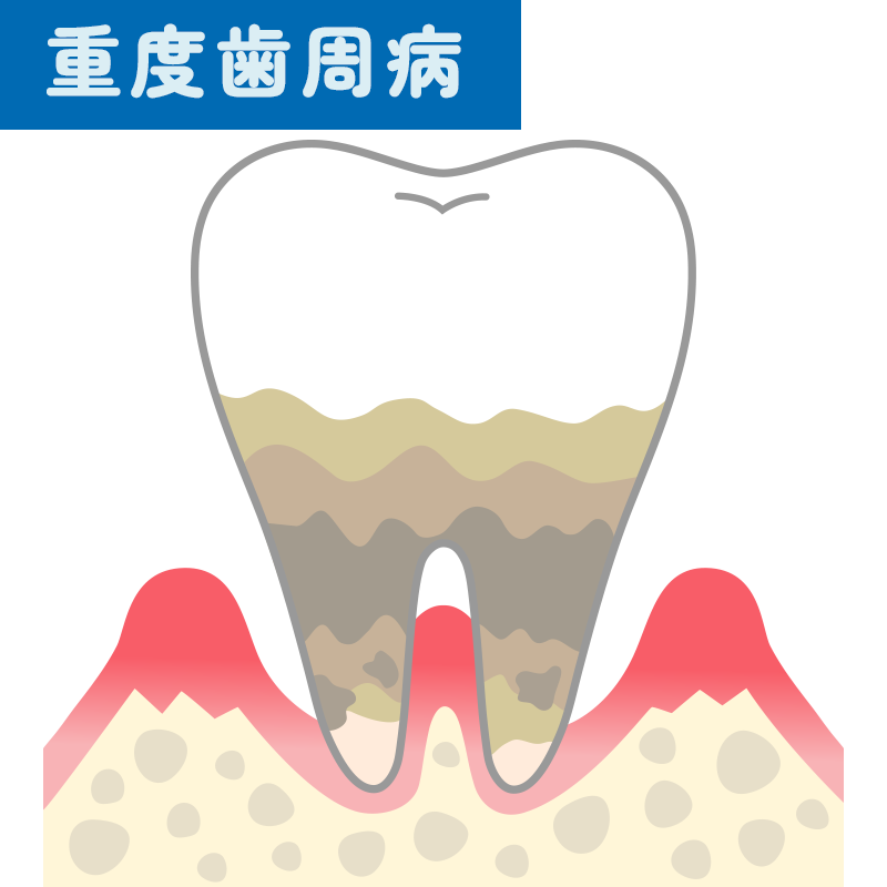 重度歯周病