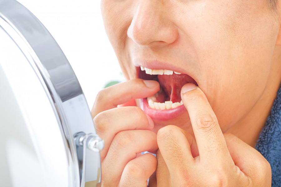 口内炎・口腔粘膜の異常